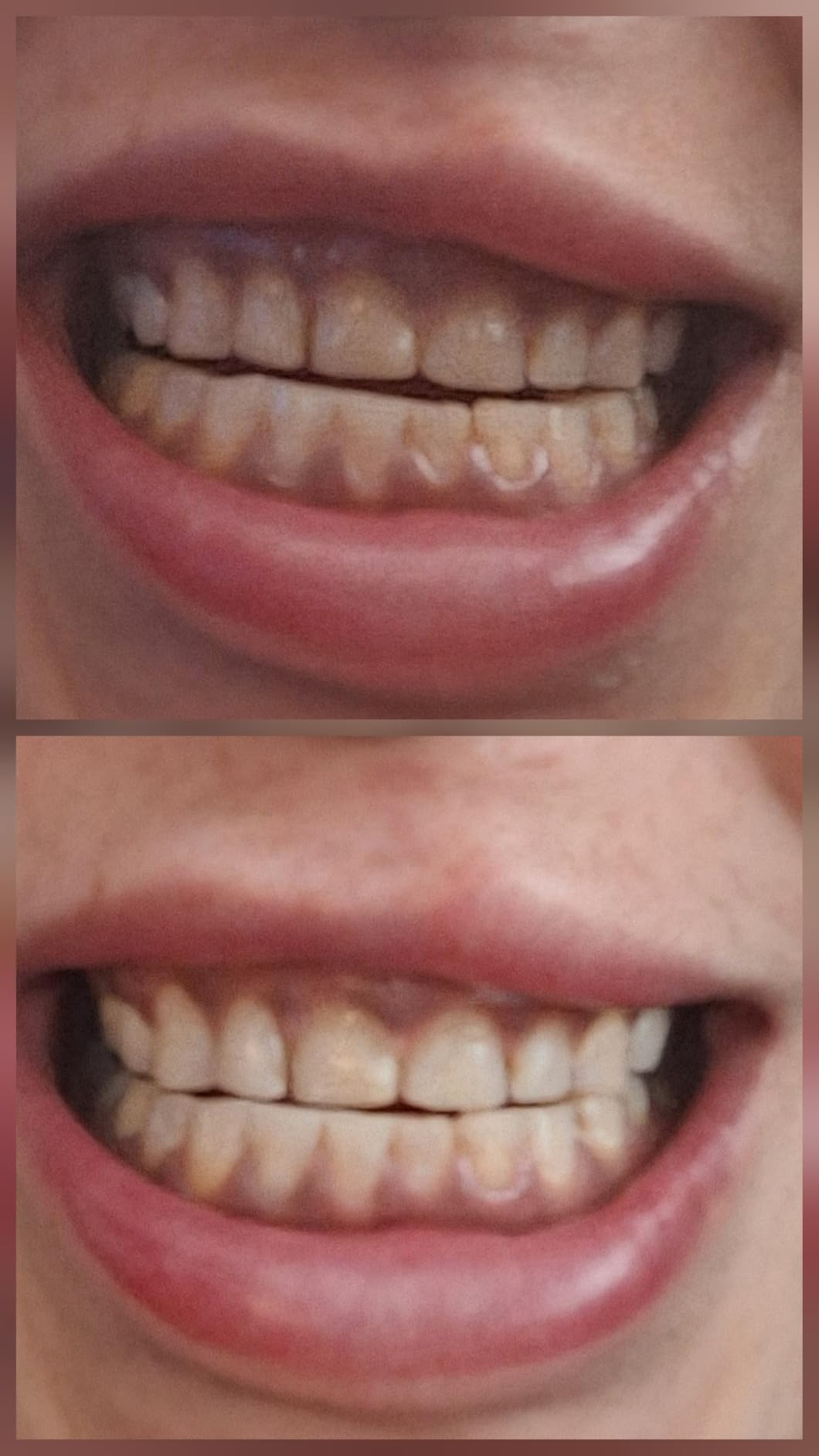 Opalescence 35% CP Mint - Gel Syringes Teeth Whitening - Refill Kit - Carbamide Peroxide Gel. Made by Ultradent. Tooth Whitening Refill Syringes 5197 (0.04 Fl Oz (Pack of 4)) customer photo 1