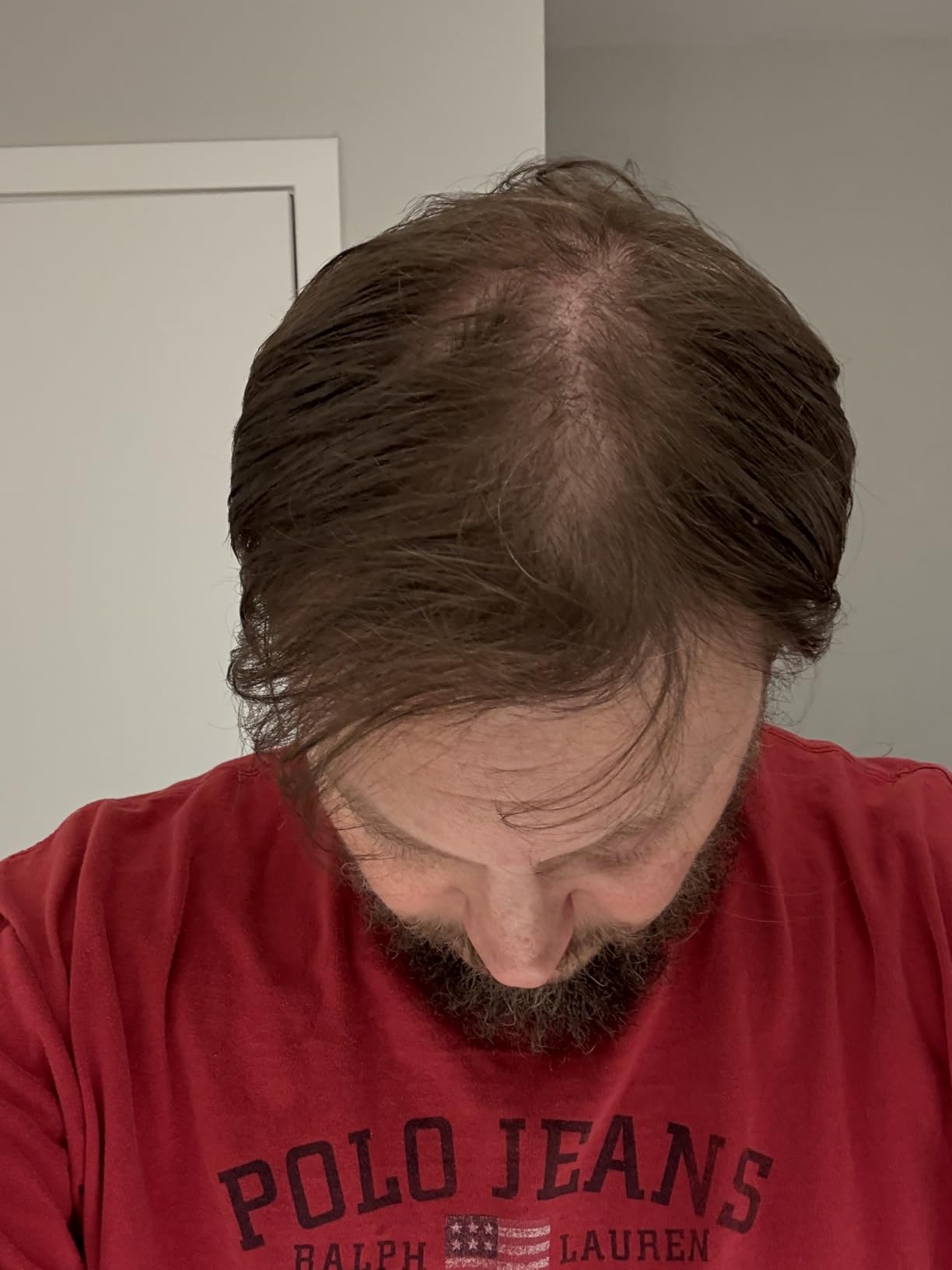 Theradome EVO Laser Hair Growth Helmet LH40 - 100% Laser, No Ineffective LEDs - FDA-Cleared Red Light Therapy for Hair Regrowth 4x Week - Made in the USA customer photo 2