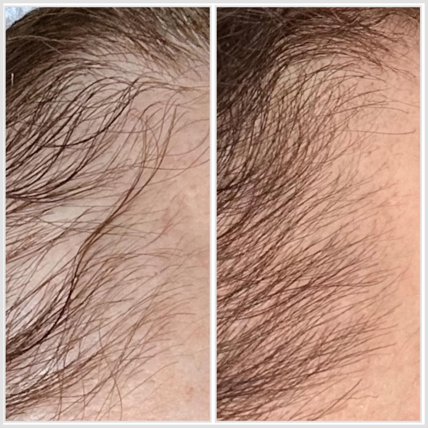 Hairmax LaserBand 82 - Hair Growth and Regrowth Treatment - Restores Natural Hair Cycle - Home-Use Medical Device With Medical Grade Lasers customer photo 1