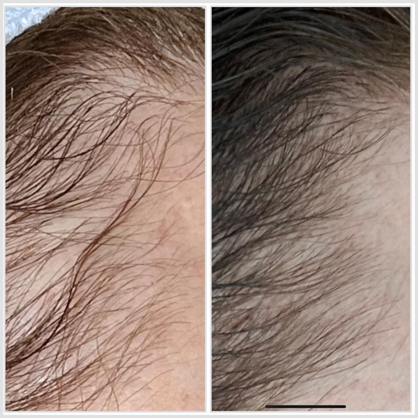Hairmax LaserBand 82 - Hair Growth and Regrowth Treatment - Restores Natural Hair Cycle - Home-Use Medical Device With Medical Grade Lasers customer photo 2