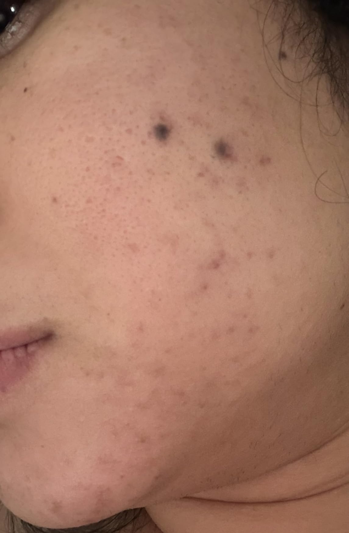 CeraVe Resurfacing Retinol Serum For Post Acne Marks, Formulated With Licorice Root Extract & Niacinamide, Brightening Serum & Pore Minimizer For Face, Non-Comedogenic customer photo 2