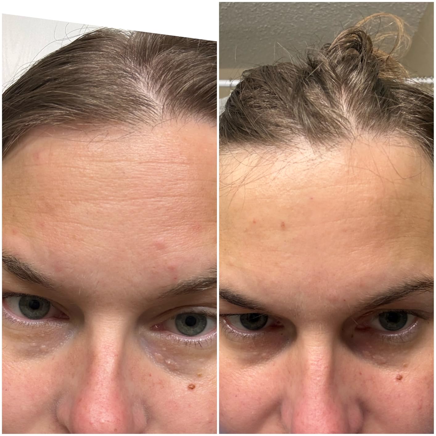 CeraVe Anti Aging Retinol Serum For Face, Encapsulated Retinol With Hyaluronic Acid, Niacinamide & Ceramides, Smooths Wrinkles & Fine Lines customer photo 1
